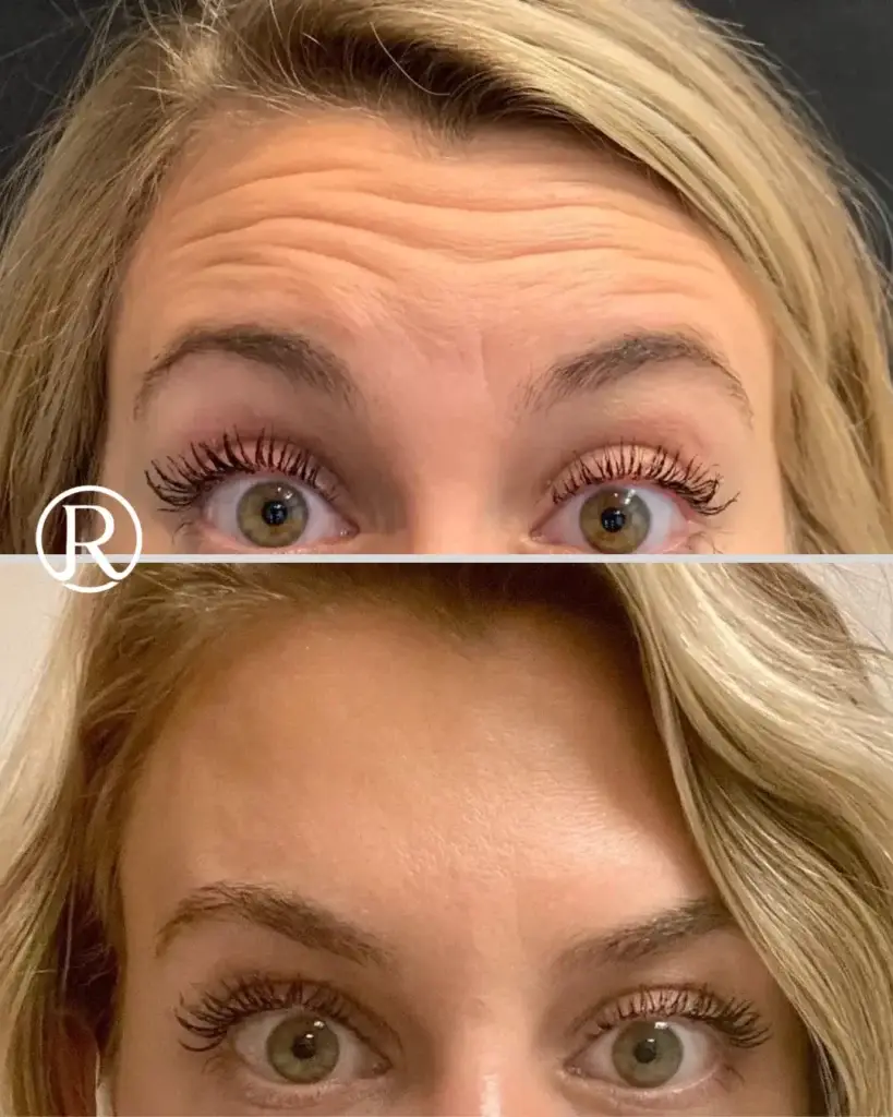 Before and After of Botox treatment