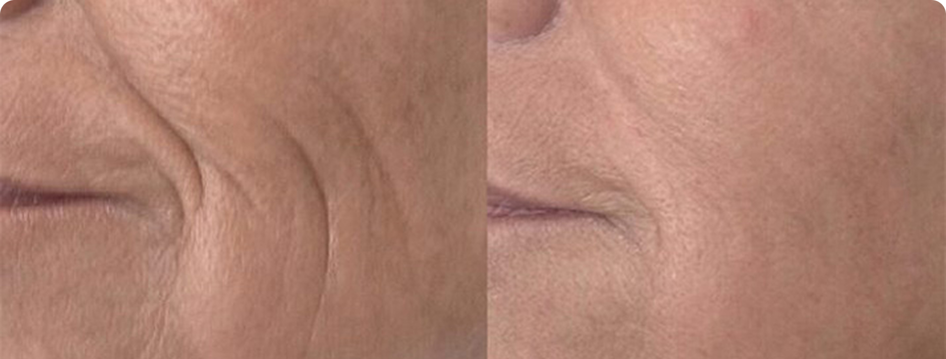 Before and After 2