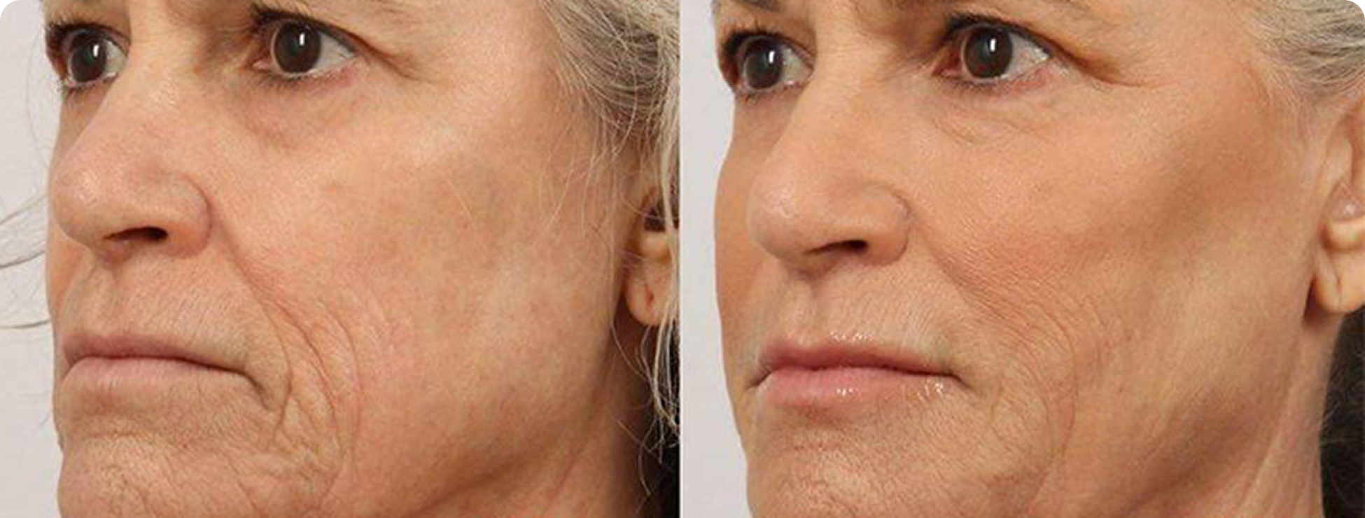 Before and After 1